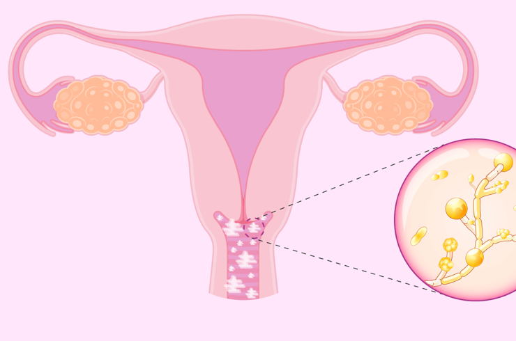 Советы гинеколога — лечение молочницы у женщин